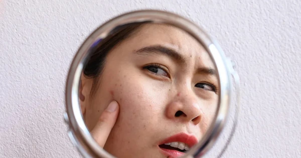 Hậu quả không thể cứu vãn từ thói quen nặn mụn