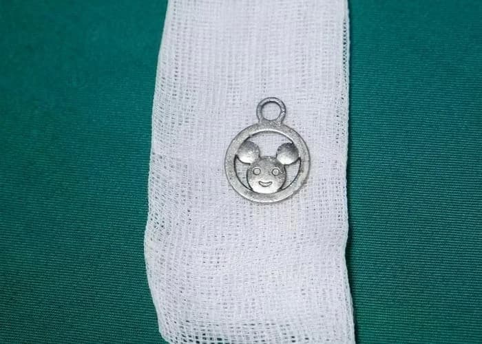 Cứu bé trai 5 tuổi vô tình nuốt móc cặp sách ở Tuyên Quang
