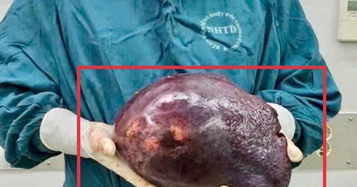 Phẫu thuật thành công khối u chiếm 70% gan, nặng hơn 2,5kg