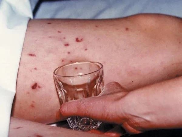 Bệnh não mô cầu diễn tiến cấp tính, lượt tiêm chủng tăng vọt