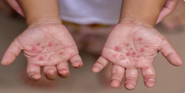 Bệnh tay chân miệng tăng mạnh, nguy cơ lây lan khi học sinh trở lại trường
