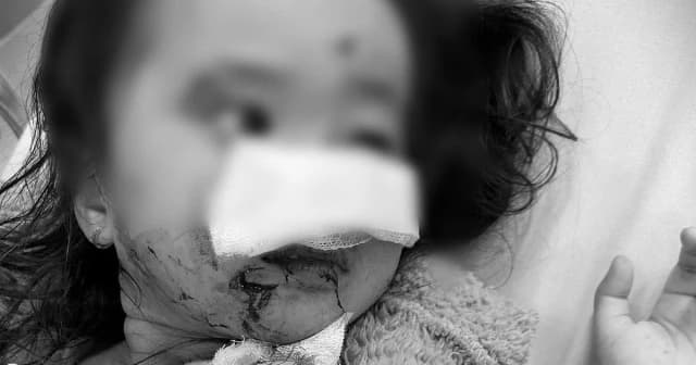 Xót xa bé gái 5 tuổi bị chó cắn vùng mặt khi chơi ở công viên ven biển