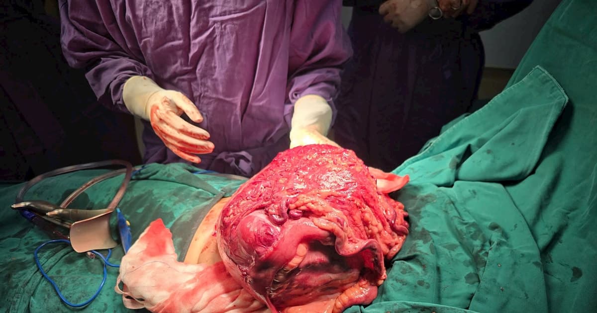 Gia Lai: Cắt bỏ khối u khổng lồ 4kg trong tử cung người phụ nữ Campuchia