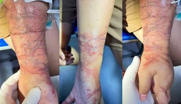 Bé gái viêm da do tiếp xúc với sứa