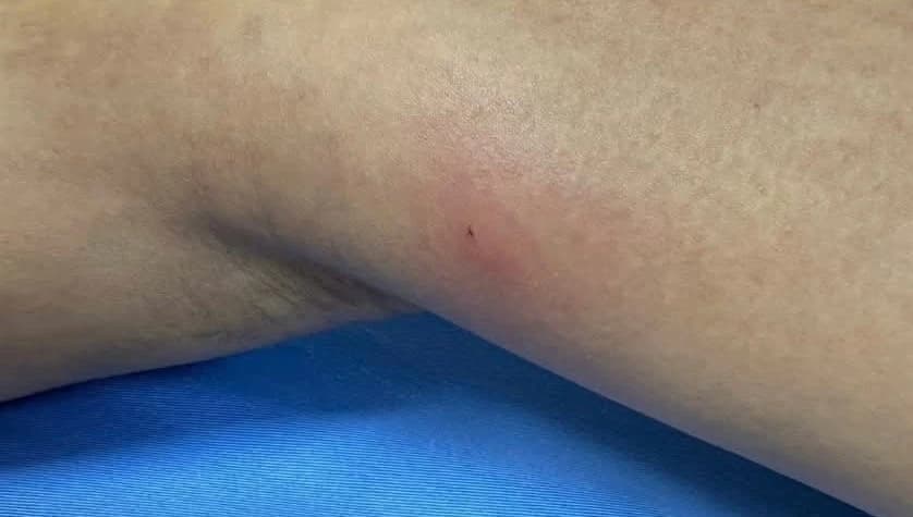 Sán dài khoảng 20 cm chui ra từ chân do thói quen ăn đồ sống