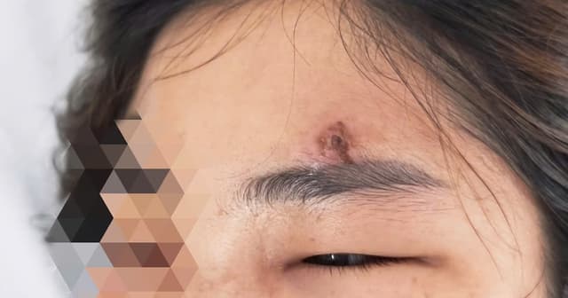 Nữ bệnh nhân tử vong vì nặn mụn tại nhà