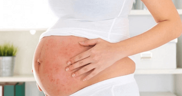 Mắc sởi khi mang bầu, nguy hiểm đối với cả mẹ và con