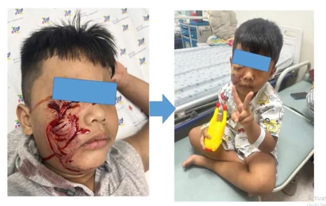 Cảnh báo tai nạn từ động vật tấn công trẻ trong mùa hè