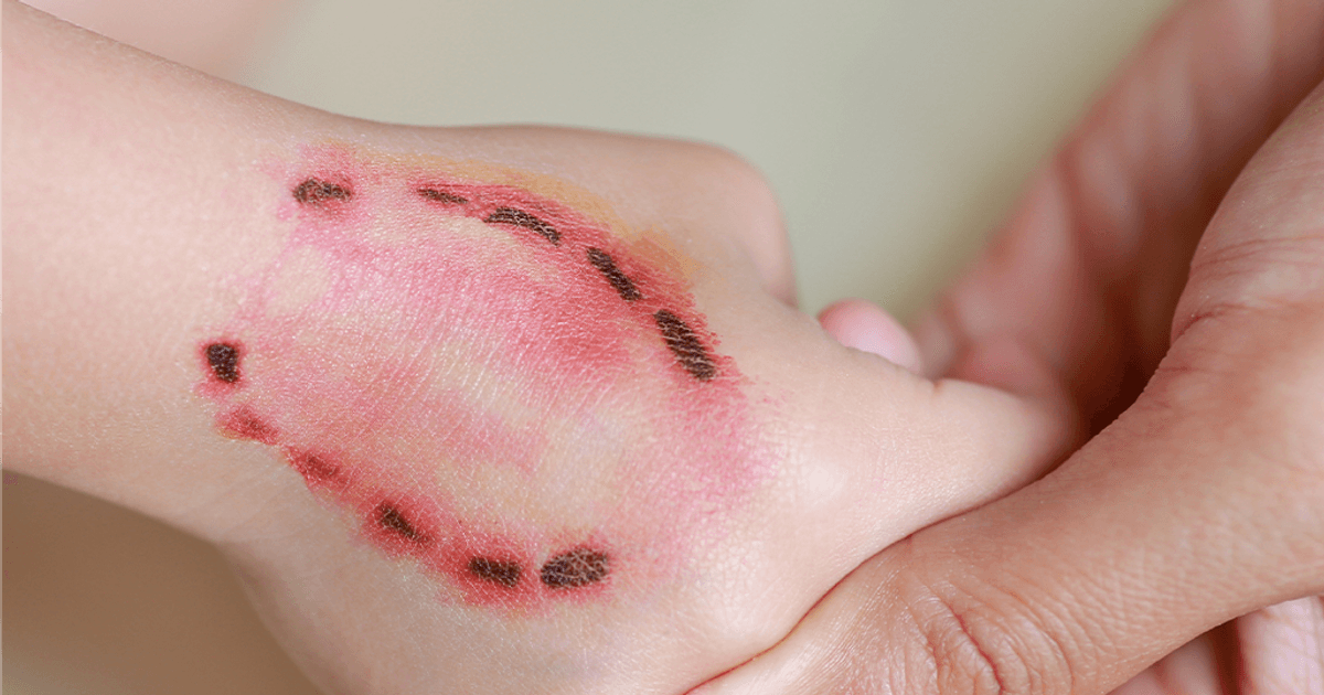 9 tháng đầu năm, 58 người tử vong vì bệnh dại