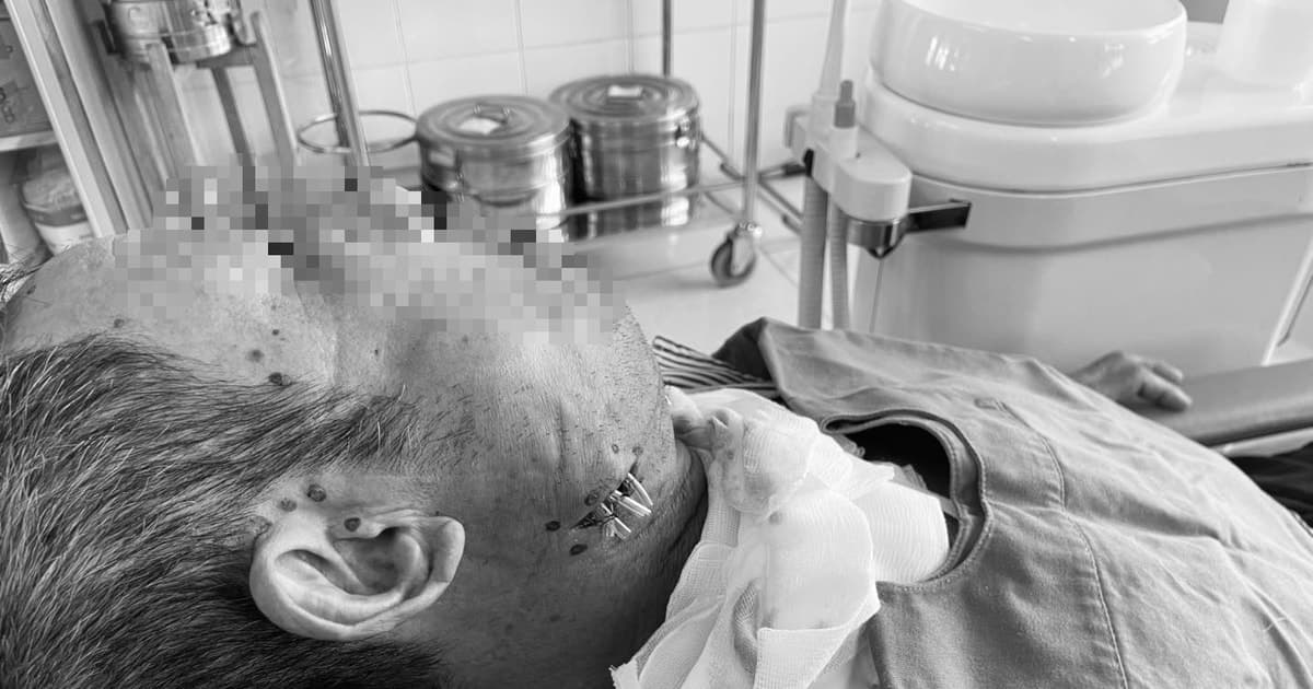 Bệnh nhân suýt tử vong vì tự đốt nhiệt chữa đau răng