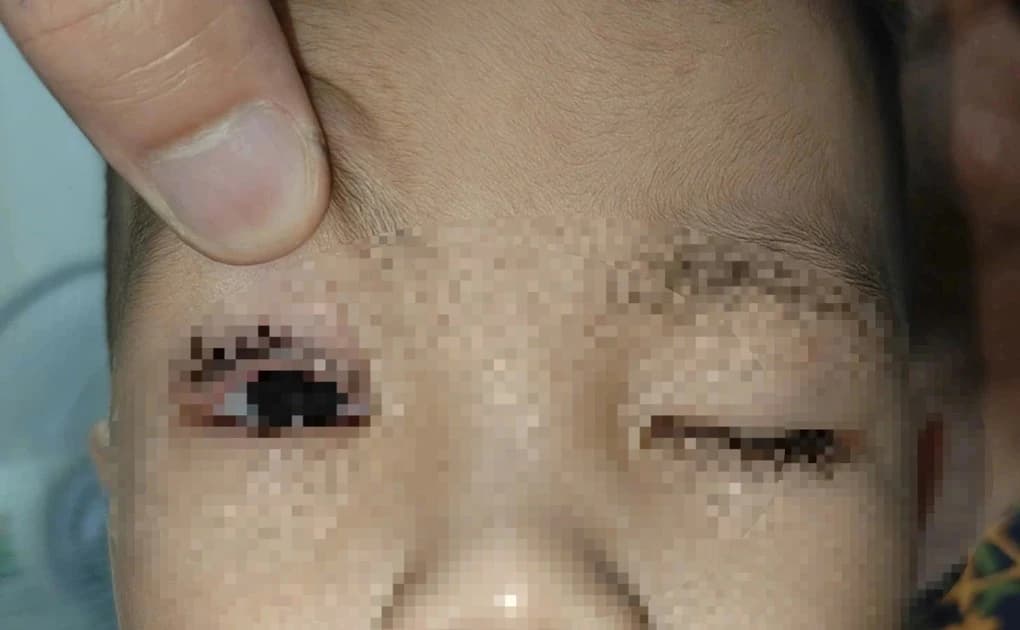 Trẻ 2 tuổi bị pháo hoa bắn trúng mắt