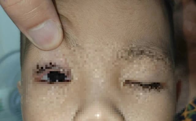 Trẻ 2 tuổi bị pháo hoa bắn trúng mắt