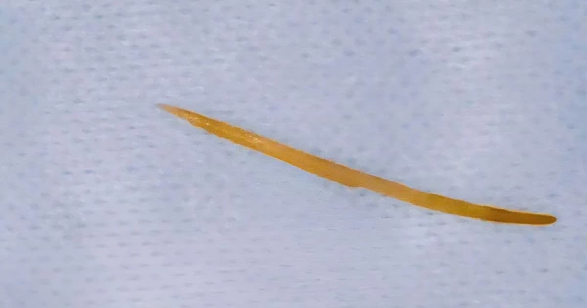 Xương cá dài 5cm đâm thủng tá tràng người bệnh