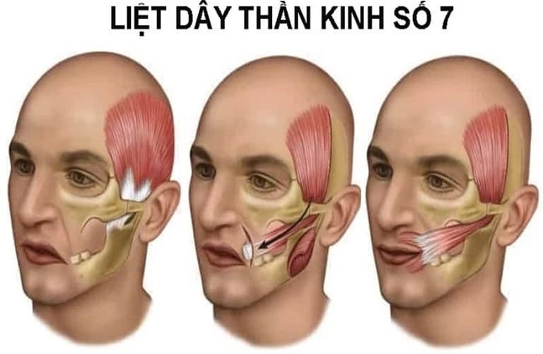 Nhiều ca liệt mặt do nhiễm lạnh kéo dài