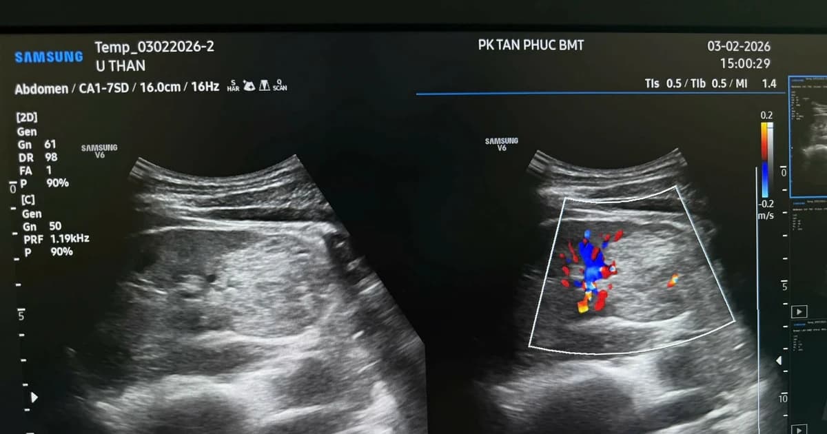 Đi khám định kỳ, người đàn ông 32 tuổi phát hiện bị ung thư thận