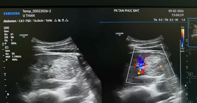 Đi khám định kỳ, người đàn ông 32 tuổi phát hiện bị ung thư thận