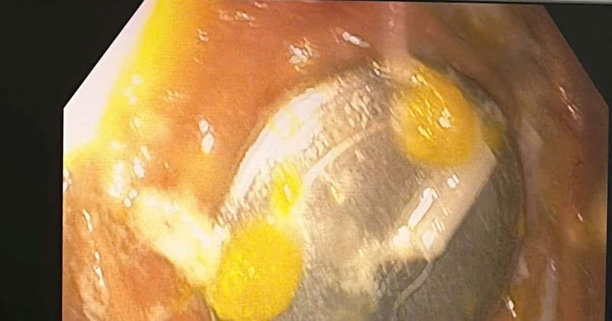 Gia Lai: Bé trai 4 tuổi nuốt đồng xu trong lúc chơi đùa