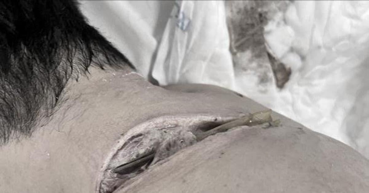 Ẩn mình trong bùn đất, tấn công bất ngờ, Whitmore có thể trở nặng chỉ sau vài ngày