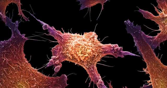 Xét nghiệm máu phát hiện đa ung thư: Khi công nghệ đi trước bằng chứng