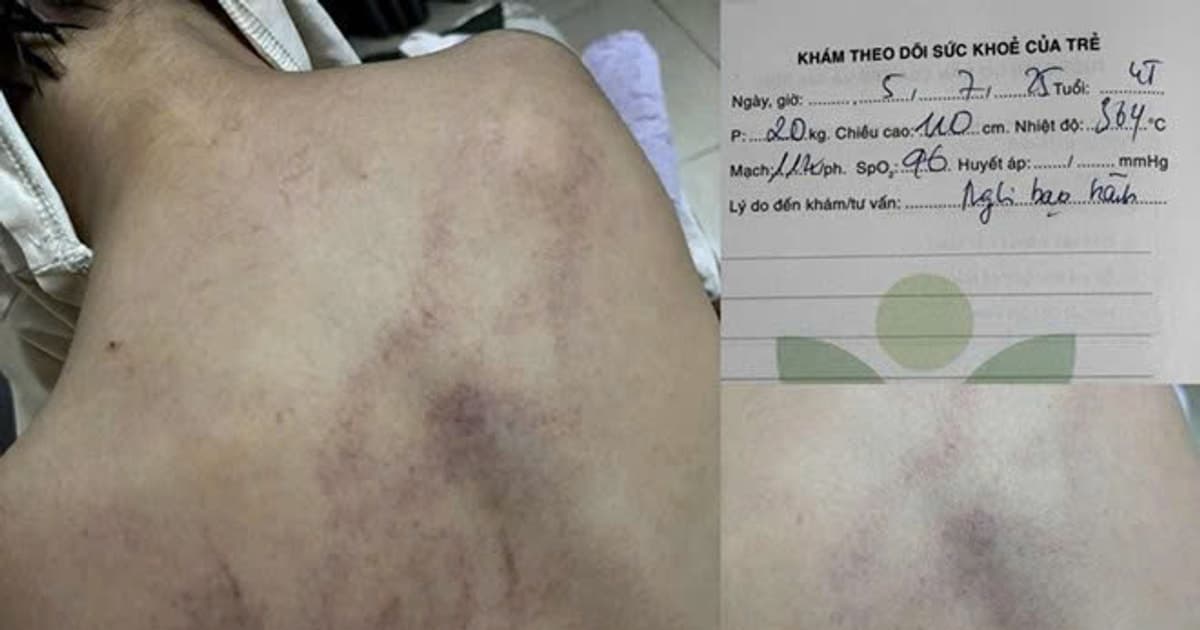 Vụ bé gái 4 tuổi bị đánh tím lưng ở Hà Nội: Đình chỉ thêm một giáo viên, điều tra dấu hiệu bạo hành trẻ