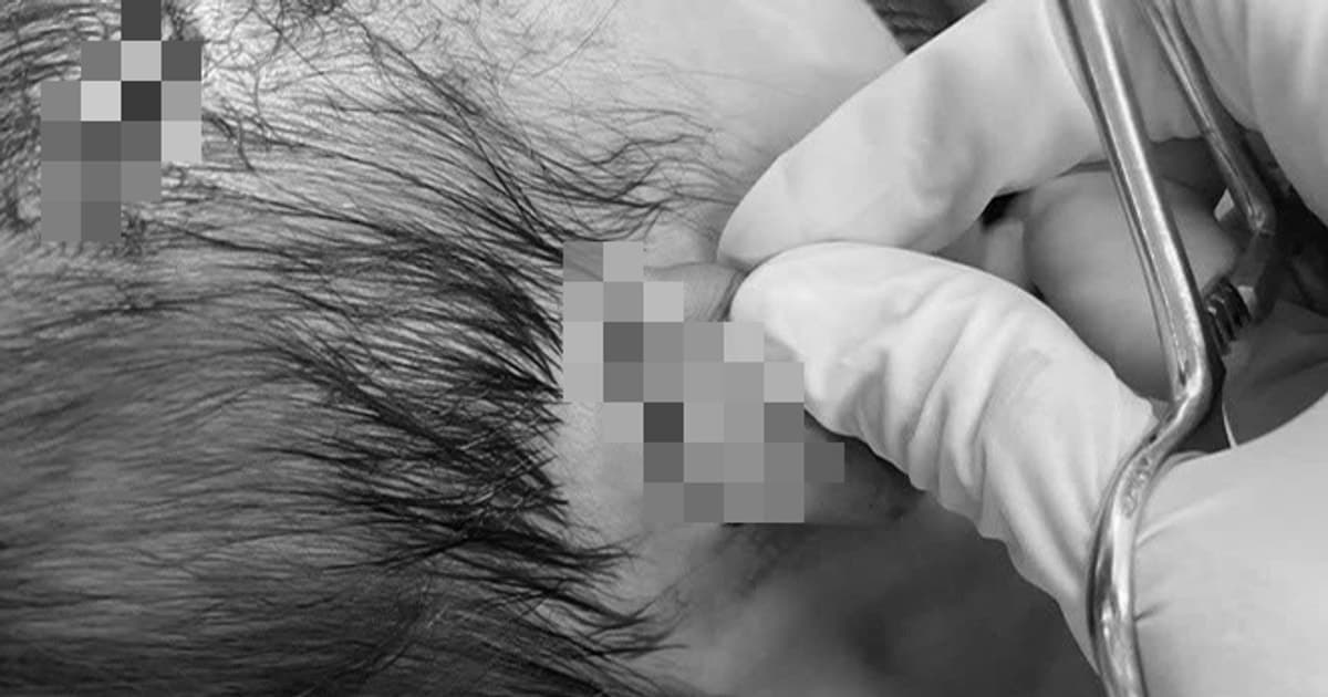 Bé gái 19 tháng tuổi bị chó cắn nguy kịch, phải tiêm huyết thanh kháng dại