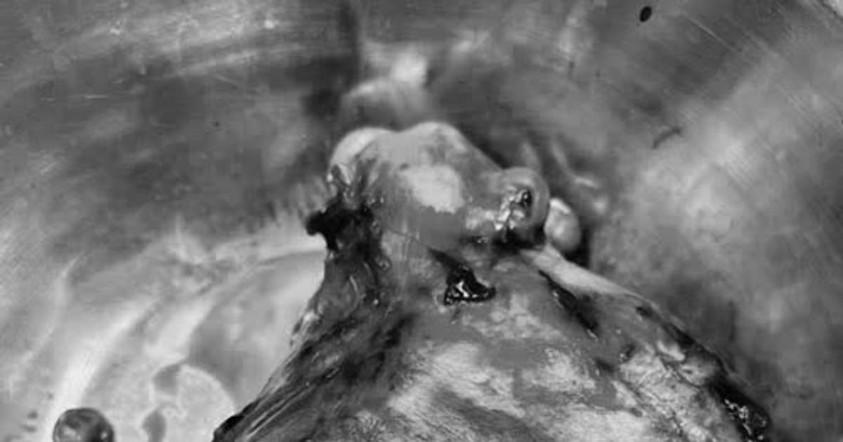 Cắt bỏ khối u xơ tử cung gần 3kg ở nữ bệnh nhân 47 tuổi