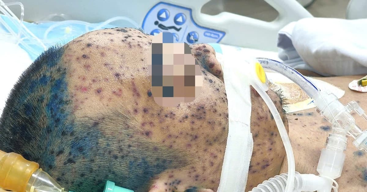 Lây thủy đậu từ con khiến người bố rơi vào nguy kịch, phải thở máy