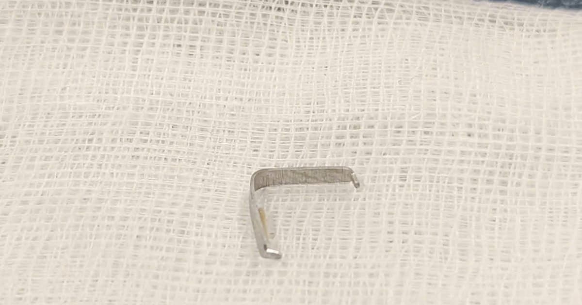 Tưởng mọc răng, bệnh nhi 1 tuổi hóc ghim kim loại nguy hiểm