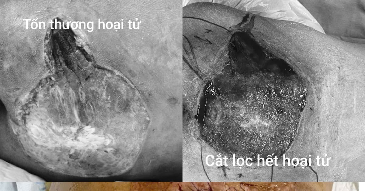 Thanh niên 17 tuổi nguy kịch vì nhiễm khuẩn nặng từ một nốt mụn nhỏ