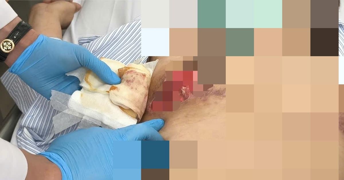 Hoại tử vòng 1, nhiễm trùng nặng sau phẫu thuật thẩm mỹ