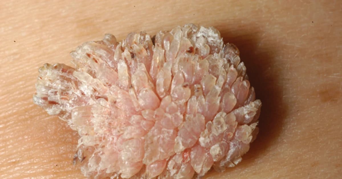 Chủ quan tự bôi thuốc, cụ ông gần 70 tuổi trả giá khi sùi mào gà lan kín vùng hậu môn