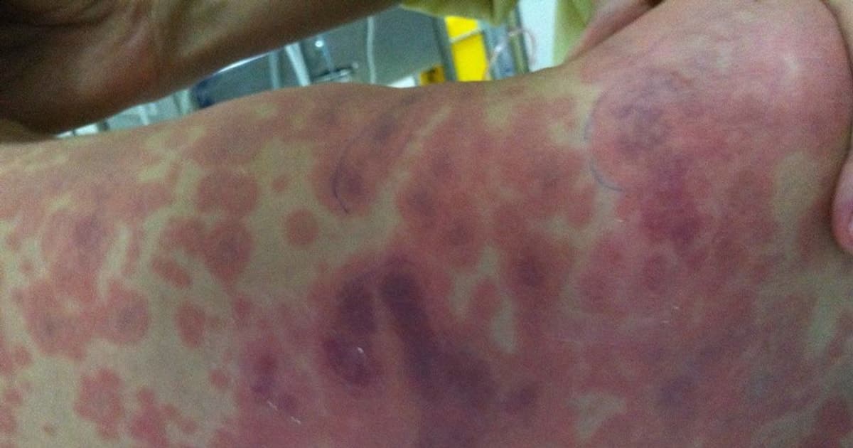 Xuất hiện 4 ca tử vong do não mô cầu, số mắc tăng so với cùng kỳ