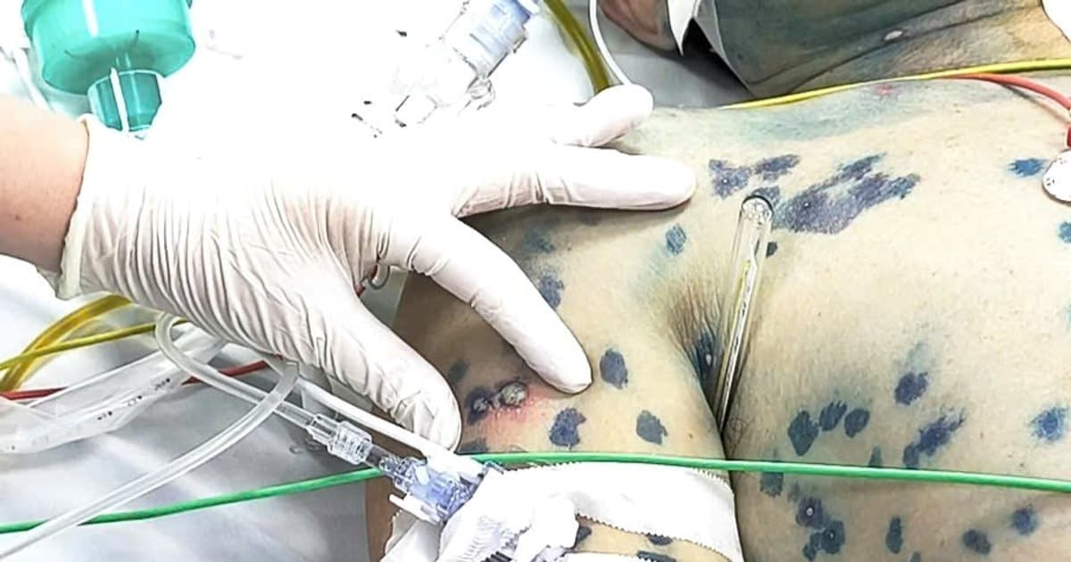 Tưởng bệnh nhẹ, nhiều người lớn nguy kịch vì thủy đậu