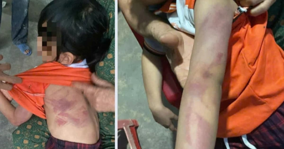 Chưa kịp cho kẹo như đã hứa, nữ sinh lớp 2 bị bạn cùng lớp đánh bầm tím