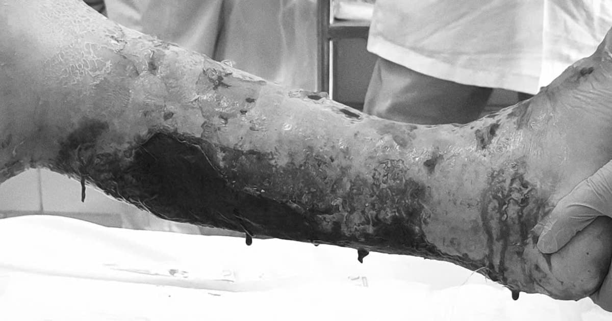 Bác sĩ lên tiếng cảnh báo khẩn trước nhiều ca bệnh hoại tử lan rộng vì xử lý sai vết thương