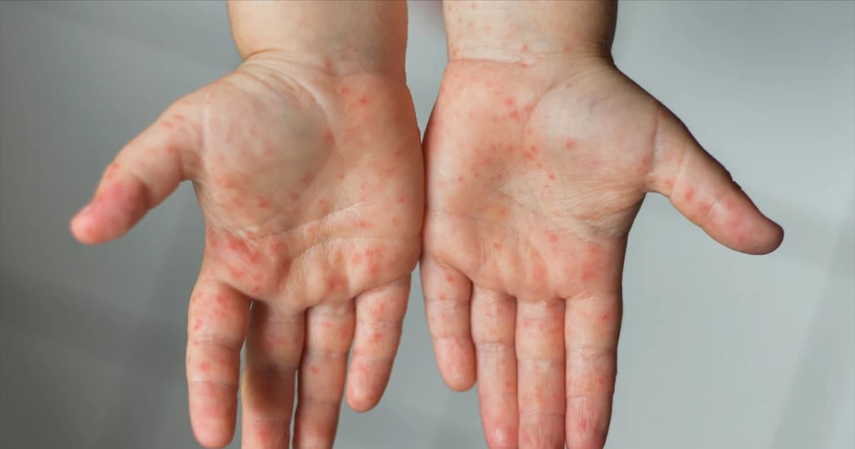 Tay chân miệng gia tăng: Cảnh giác dấu hiệu không điển hình