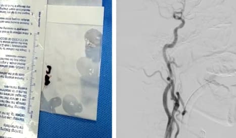 Bệnh viện Trường Đại học Y - Dược Huế cứu sống ca nhồi máu hiếm gặp